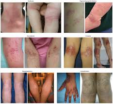 Image result for Atopic eczema atopic dermatitis