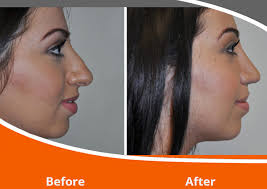 Click ok to enable the app to access your camera for the visit. Rhinoplasty Adelaide Norwood Day Surgery