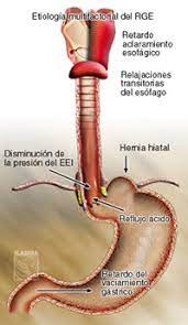 Reflujo Laringofaringeo