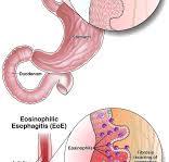 Eosinophilic esophagitis (EoE) - AGA GI Patient Center