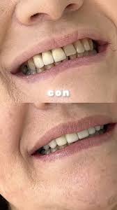 (P) Transforma tu sonrisa con @omdental_ec