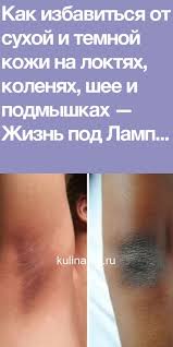 как убрать раздражение в зоне бикини в домашних условиях Kak Izbavitsya Ot Suhoj I Temnoj Kozhi Na Loktyah Kolenyah Shee I Podmyshkah Beauty Health Health Healthy Tips