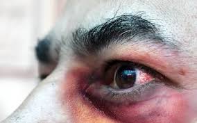 Entérate de quiénes están en riesgo de contagiarse con el «hongo negro» Hongo Negro Llega A Guerrero Detectan Dos Casos El Sol De Mexico Noticias Deportes Gossip Columnas