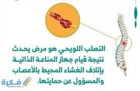 ما هي أعراض الإصابة بالديسك؟. Ù…Ø§ Ù‡Ùˆ Ù…Ø±Ø¶ Ø§Ù„ØªØµÙ„Ø¨ Ø§Ù„Ù„ÙˆÙŠØ­ÙŠ Ù…ÙˆÙ‚Ø¹ ÙÙƒØ±Ø©