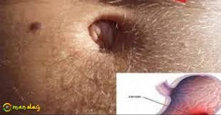 The cancer has spread just underneath the first layer of stomach tissue but hasn't yet invaded the muscles. Cancer In The Stomach Develops Silently These Are The First Signs It Is Important That You