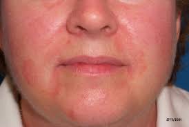 Maybe you would like to learn more about one of these? Seborrhoisches Ekzem Deximed