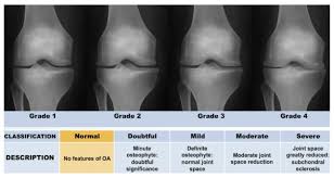 Image result for Knee XRay