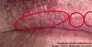 The cherry angioma are in my hairline and i'm pale so although they're small they're noticeable. Why Do You Have These Small Spots On Your Lips Lip Allergy Small Bumps On Lips Blister On Lip