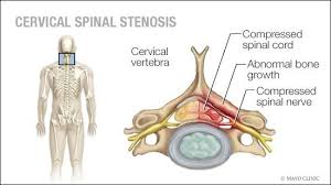 Mayo Clinic Q And A Treating Cervical Spinal Stenosis Mayo Clinic News Network Cervical Spinal Stenosis Spinal Stenosis Stenosis