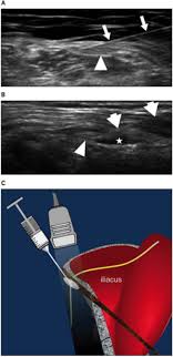 We did not find results for: Treatment Of Meralgia Paresthetica Lateral Femoral Cutaneous Neuropathy A Meta Analysis Of Ultrasound Guided Injection Versus Surgery European Journal Of Radiology