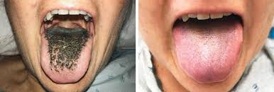 So wies etwa der dermatologe peter elsner im gespräch mit focus. Schwarze Haare Auf Der Zunge Springerlink