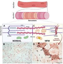Image result for Myopathy