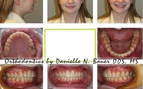 Herbst Appliance Mara Appliance Wheaton Orthodontist Bauer Smiles