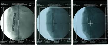850 titanium metal detector products are offered for sale by suppliers on alibaba.com, of which industrial metal detectors accounts for 1%, testing equipment accounts for 1%. X Ray Radiographs Of A Stainless Steel Implant A A Titanium Implant Download Scientific Diagram