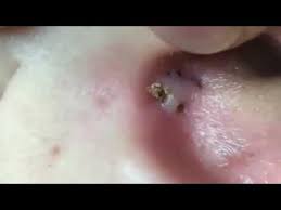 Deep blackheads on your nose? Deep Blackheads Removal From Cheeks And Nose Best Pimple Popping Videos Youtube
