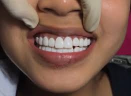 Veneer direct maupun indirect ini berbeda dengan perawatan bleaching gigi. Vivi Beauty Veneer Gigi Usa Extra White Promo Paket Facebook