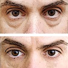 Eyebagsundereyes Eye Bags Treatment Laser Eye Surgery Cost Sagging Skin