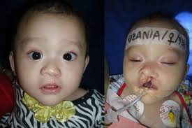 Fundraiser by Frank Musgrove : Hare Lip and Cleft Pallette Surgeries