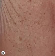 Image result for Diffuse Hyperpigmentation