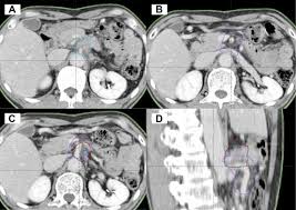 How Much Was The Elective Lymph Node Region Covered In Involved Field Radiation Therapy For Locally Advanced Pancreatic Cancer Evaluation Of Overlap Between Gross Target Volume And Celiac Artery Superior Mesenteric Artery Lymph Node