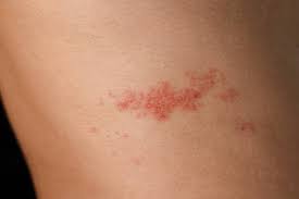Image result for Varicella zoster on human skin