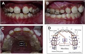 If a crossbite is not corrected in early childhood. Simple Removable Appliances To Correct Anterior And Posterior Crossbite In Mixed Dentition Case Report Sciencedirect