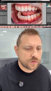 Caso clínico: seguimiento a 6 años, En 2019 se realizó el reemplazo de dos  carillas en resina por carillas cerámicas estratificadas en incisivos  centrales., Procedimiento:, • Retiro de las ...