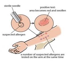 How To Perform Skin Testing Nursing Crib