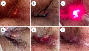 Image result for Perianal Abscess