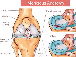1 48 female medial femoral condyle 2 58 female retropatallar 3 35 male medial femoral condyle 4 19 male lateral femoral condyle 5 52 female 11 outerbridge re. Meniscus Vs Cartilage Tear Of The Knee
