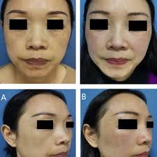 Radiological finding 3 years after successful autotransplantation of...