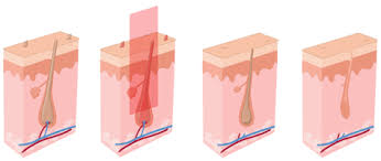 Make sure you have some sort of money back guarantee, if that's a. Laser Hair Removal London Courthouse Clinics London