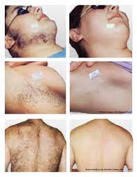 Silk'n infinity hair removal device at amazon. Laser Hair Removal Face Cost Off 62 Online Shopping Site For Fashion Lifestyle