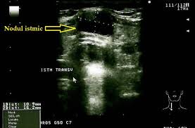 Interferente analitice la analiza ac. Pagina 6 Tiroida Ro