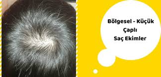 Bolgesel Sac Ekimi Nedir Nasil Yapilir Sac Ekim Sac Ekim Fiyat Dhi Sac Ekim