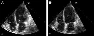 Myocarditis echo features (page 1). Eosinophilic Myocarditis Due To Churg Strauss Syndrome Mimicking Reversible Dilated Cardiomyopathy Heart Lung The Journal Of Cardiopulmonary And Acute Care