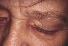 Image result for xanthelasma of eyelid