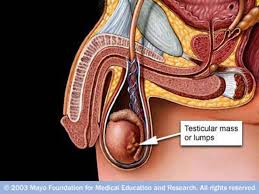 Ramdev konijeti discusses commonly asked questions. Testicular Cancer The Most Common Cancer Affecting Young Men In Their Third Or Fourth Decades Of Life Relatively Rare 1 1 5 Of All Cancer In Men Highly Ppt Video Online Download