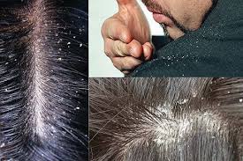 It is very important to drink plenty of water daily to help your overall health as well as the dryness of your skin and scalp. 2 Home Remedies To Get Rid Of Dandruff Naturally
