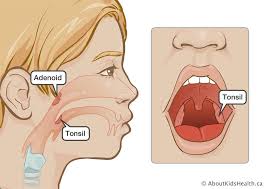 Tonsil Surgery Or Tonsil And Adenoid Surgery Caring For Your Child After The Operation