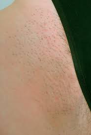 Laser hair removal unwanted leg hair can be a huge inconvenience. Before After Laser Hair Removal Before After Seduire London Laser Hair Removal Beauty Treatments In Soho London