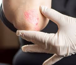 Uv Light Therapy Centreville Va Trained Professionals