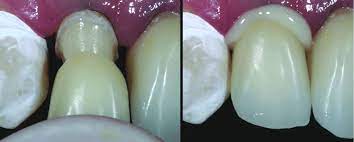 Follow a simplified process in veneer cementation. Convention Resin Cementation Of Laminate Veneers Right Central And Download Scientific Diagram