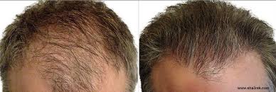 نقاط هامة في تحديد تكلفة زراعة الشعر Ear Tattoo Behind Ear Tattoo Ear