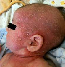 File Atopic Dermatitis Child 1 Jpg Wikimedia Commons