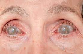 Facts and prevalence of diabetes. What Is Diabetic Retinopathy Royal Spanish Center