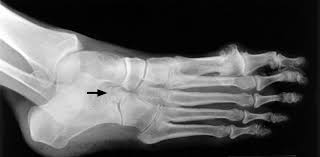 Image result for Calcaneus Compression Fracture