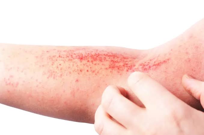 Nổi mẩn đỏ ngứa như muỗi đốt: Nguyên nhân và cách xử lý • Hello Bacsi