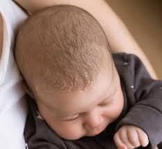Image result for Cradle Cap