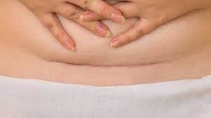 Despite how common the procedure has become, c . C Section Archives Fit And Healthy Mums